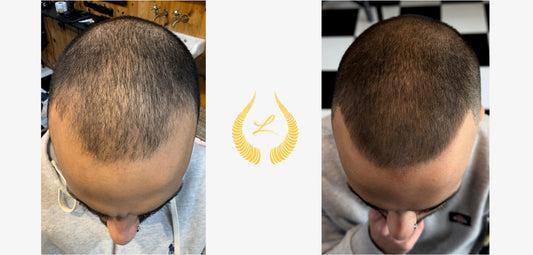 Hair loss scalp analisys